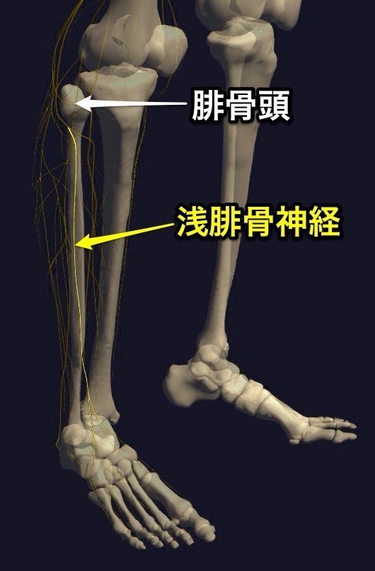 腓骨神経麻痺